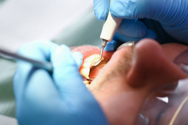 Best Emergency Treatment for Dental Infections or Abscesses in Baldwin, FL